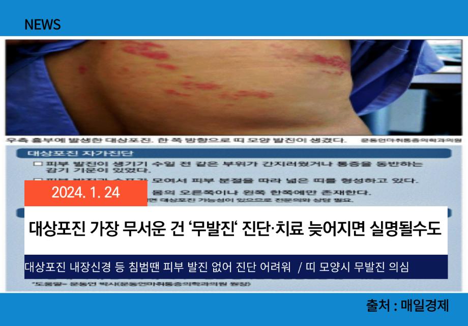 [매일경제] 대상포진 가장 무서운 건 ‘무발진‘ 진단·치료 늦어지면 실명될수도 이미지