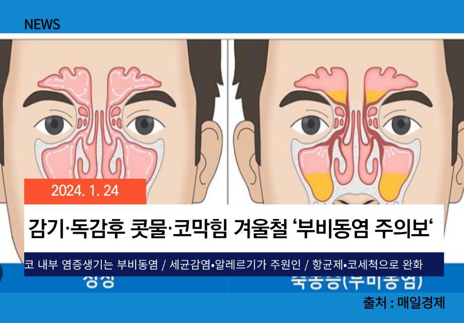 [매일경제] 감기·독감후 콧물·코막힘 겨울철 ‘부비동염 주의보‘ 이미지